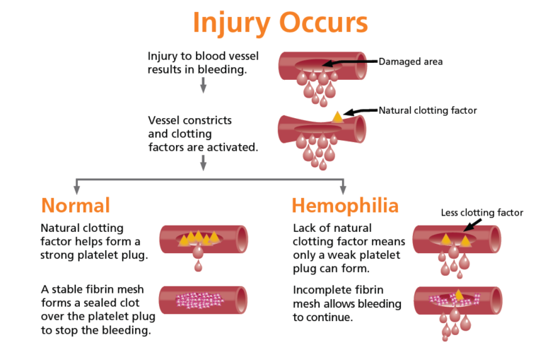 HAEMOPHILIA | MetroHealth HMO