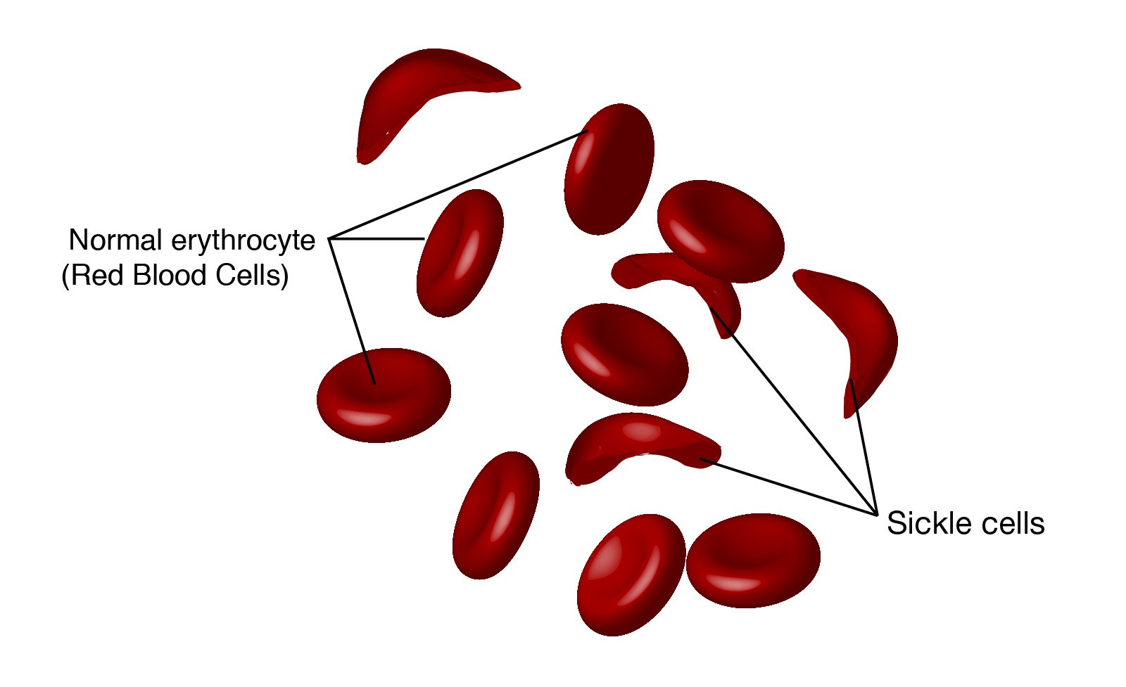  Sickle Cell Disease SCD MetroHealth HMO