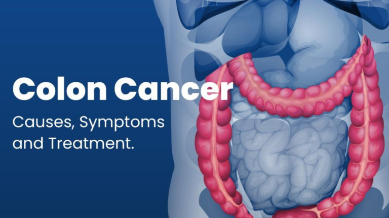 Colon Cancer Causes Symptoms And Treatment Metrohealth Hmo 3317