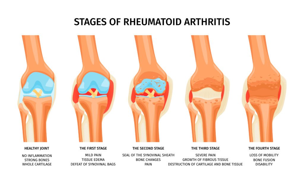 rheumatoid arthritis