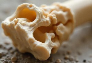 osteoporosis bone disease