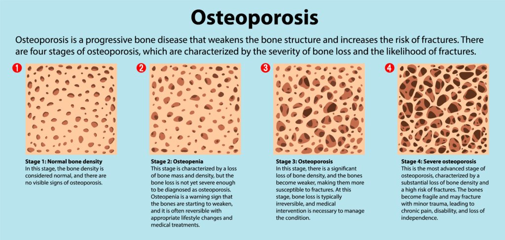 Bone density and osteoporosis vector illustration